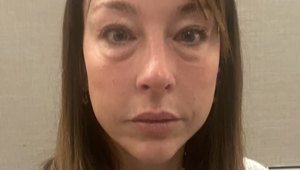 Dvojnásobná mama minula úspory, aby sa zbavila vačkov pod očami: Omladla o 10 rokov!