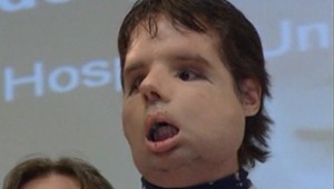 Unikátna transplantácia tváre: Oscar môže opäť hovoriť!