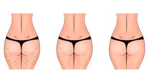 Nezmierte sa s pomarančovou kožou! Tento super TRIK nedá celulitíde šancu