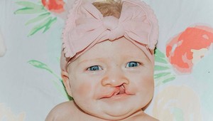 Narodila sa s výrazným rázštepom, lekári odviedli skvelú prácu: Aha, ako vyzerá dnes!