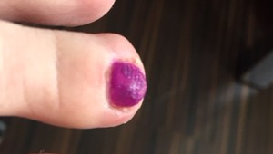 Zarastajú vám nechty na nohách? Podologička: Robíte túto chybu