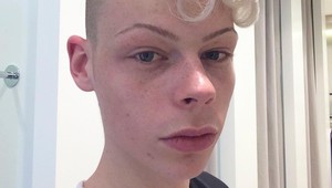 Takto už nevyzerá! Patrick si plastikami plní sen, odpadnete, čo so sebou urobil!