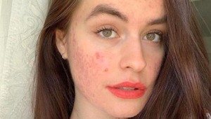 Sofia už nemieni maskovať svoju tvár: Som šťastná a úspešná aj s AKNÉ!