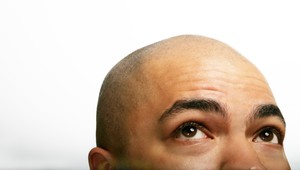 Muži bez plešiny? Vedci vyvíjajú špeciálny krém