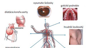 Syndróm, ktorý  spôsobuje roztrhnutie aorty aj u mladých ľudí: Trpel ním známy moderátor