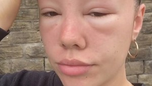 Žena si myslela, že sa spálila na slnku, dopadla ešte horšie: TOTO v horúcom počasí nepodceňujte!