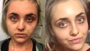 Od detstva ju trápil ekzém po celom tele: Paula zmenila jednu vec a za pár dní sa vyliečila