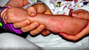 Epidémia osýpok sa priblížila k Slovensku