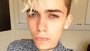 Túžil vyzerať ako na fotke so snapchat filtrom: Čo poviete na jeho tvár po plastike?