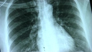 Vedci objavili nový typ buniek v pľúcach. Pomáhajú nám správne dýchať