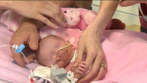Narodila sa so srdcom mimo tela. Dnes má tri týždne, za sebou tri operácie a žije