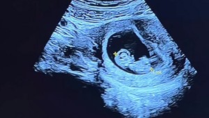 Predčasný koniec sezóny. Táto lyžiarka čaká DIEŤA!