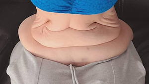 Schudla neuveriteľných 95 kíl, s týmto však nepočítala: KILÁ ovísajúcej kože ju roky ničili!