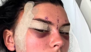 Nelly chcela líščie oči, podstúpila bolestivú operáciu: Pozrite sa na TEN výsledok!