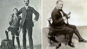 Narodil sa s tromi nohami a dvomi penismi: Napriek tomu prežil úspešný život