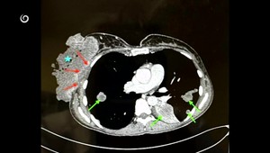Mamografia je dostupnejšia, záujem žien o preventívne vyšetrenie je stále nízky