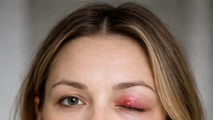 Opuchlo vám viečko? Príčin môže byť viacero, toto sú tie časté