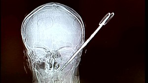 Žena zapichla mužovi nožnice do hlavy, ten zázrakom prežil