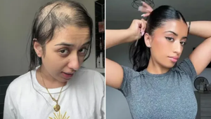 Rok pred svadbou prišla takmer o všetky vlasy: TOTO žene pomohlo!