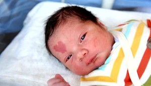 FOTO: Chlapček má na čele znamienko v tvare srdca