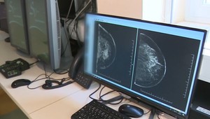 Po internete sa šíri nebezpečný hoax. Rozširuje nepravdy o škodlivosti mamografie