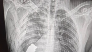 Chirurgovia odstránili z hrude vojaka nevybuchnutý granát