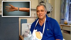 Mark (51) prišiel o pravú ruku. Transplantovali mu novú