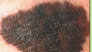 Lekárka:  Pacienti s rakovinou kože mi hovoria- veď ma to doteraz nebolelo...