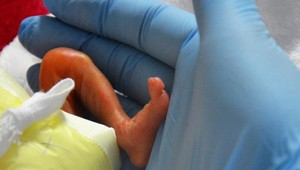 Dievčatko po narodení vážilo len 322 gramov. Zachránili ju matky a lekári