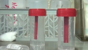 Riešenie na problémy po črevných zápaloch: Fekálna transplantácia môže pomôcť aj vám