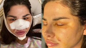 Exkluzívne FOTO Plačkovej po plastike tváre: Na toto čakala viac ako rok a konečne vidí výsledok!