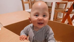 Chlapček so zdeformovanou hlavou dostal druhú šancu: Aha, ako vyzerá po operácii