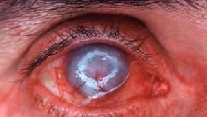 Parazit, ktorý požiera oči: Ohrozuje hlavne nositeľov šošoviek, vyskytuje sa aj na Slovensku