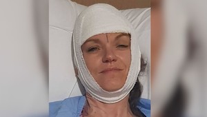 Stroj jej odtrhol pokožku hlavy. Žena prešla 200 metrov, aby našla pomoc