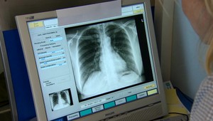 Ak sa vám menia pľúca na väzivo, týchto 7 príznakov vás upozorní