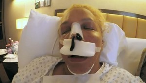 Túžila po dokonalom nose, zažila hotové muky: Ako vyzerá jej tvár po ôsmich zákrokoch?