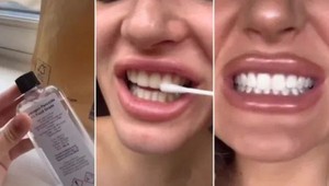 Sociálne siete ovládol nový spôsob bielenia zubov: Za žiarivým chrupom je však háčik