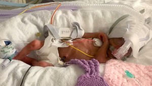 Úžasná bojovníčka: Narodila sa menšia ako balíček cukru, teraz oslavuje 1 rok