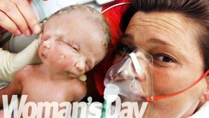 V Austrálii sa narodili unikátne siamské dvojčatá