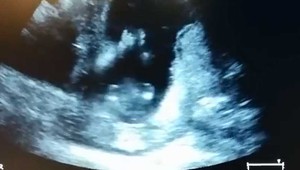 Úžasné video! To sme ešte nevideli: Bábätko v brušku tlieska rukami