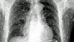 Telo muža zamorili po konzumácii mäsa parazity