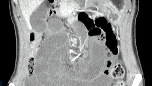 Žene objavili v bruchu drôt zo strojčeka na zuby. Nosila ho pred 10 rokmi