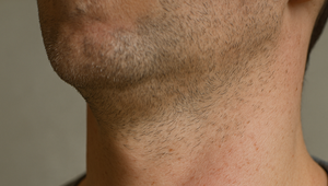 Nie je to len problém žien! Mužom kvôli HPV hrozí rakovina penisu aj krku, varujú odborníci