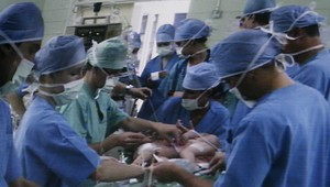 Oddelili siamské dvojčatá zrastené hlavami