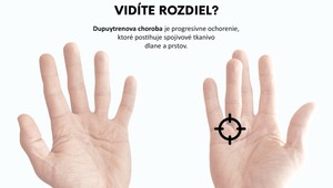 Unikátny liek na Dupuytrenovu kontraktúru-inovácia bez potreby operácie