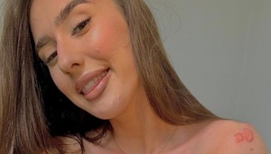 Po akné jej zostali škaredé jazvy na chrbte, takto TO vyriešila: Z hendikepu urobila prednosť!