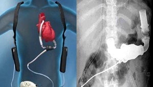 Umelé srdce: Pumpa zachraňuje životy aj na Slovensku!
