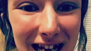 Žena so žraločími zubami po radikálnej premene: Konečne sa môže usmievať!