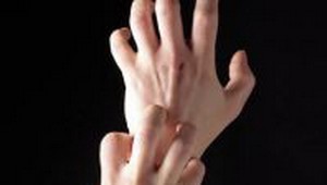 Psoriáza nie je nákazlivá