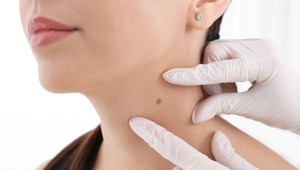 Chcete kožné vyšetrenie na Trhu kože bez čakania a zadarmo? Zaregistrujte sa včas